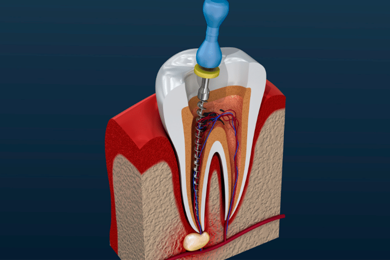 Endodoncia